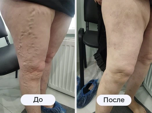 фотография до и после лазерного лечения варикоза в клинике Варикоза нет в Волгограде
